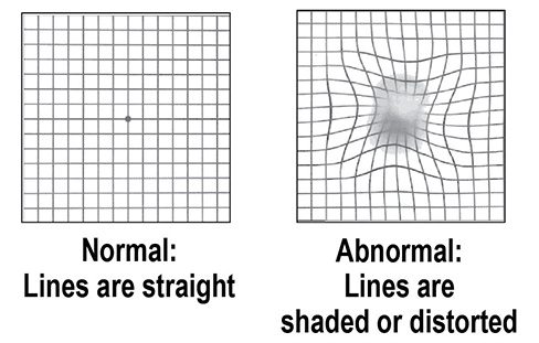 Amsler-Grid-side-by-side-normal-and-adnormal